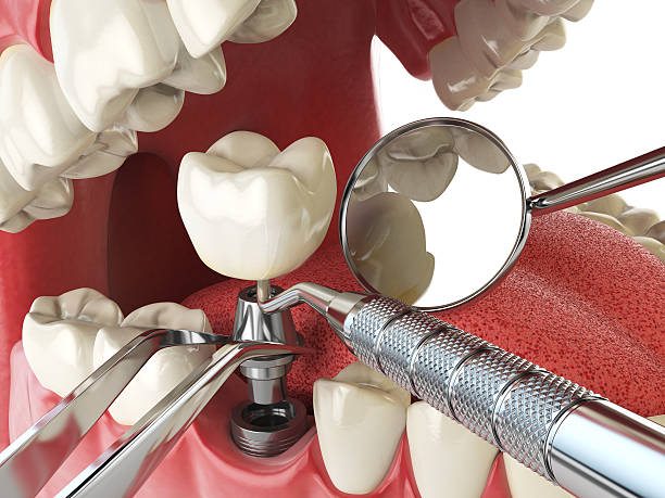 Best Emergency Dental Care for Sports Injuries in Hickory, NC